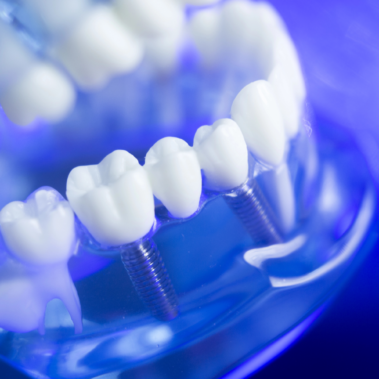 Zahnimplantate